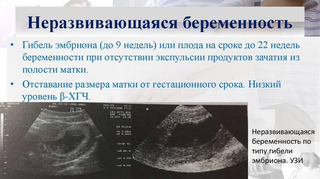 Замершая беременность: возникновение и диагностика