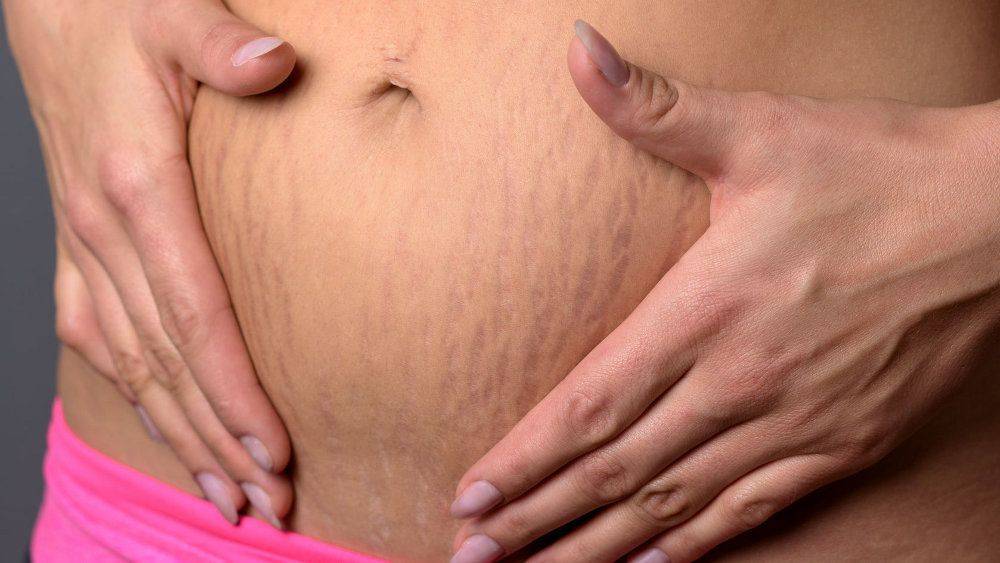 Почему возникают стрии у беременных? лучшие средства от растяжек при беременности