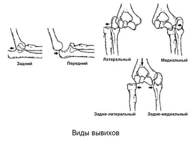 Вывих и подвывих схема