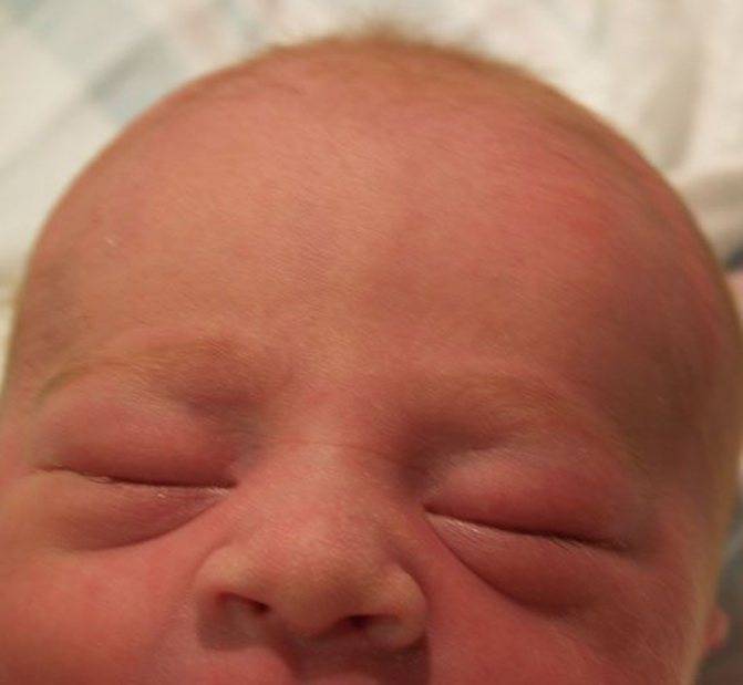 Причины закатывания глаз у новорожденных