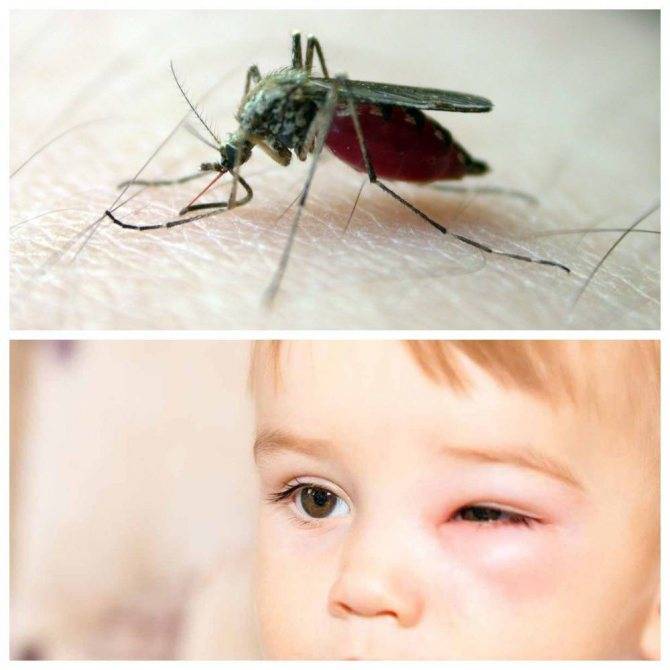 Сыпь у ребенка: аллергия, инфекция или укусы насекомых?