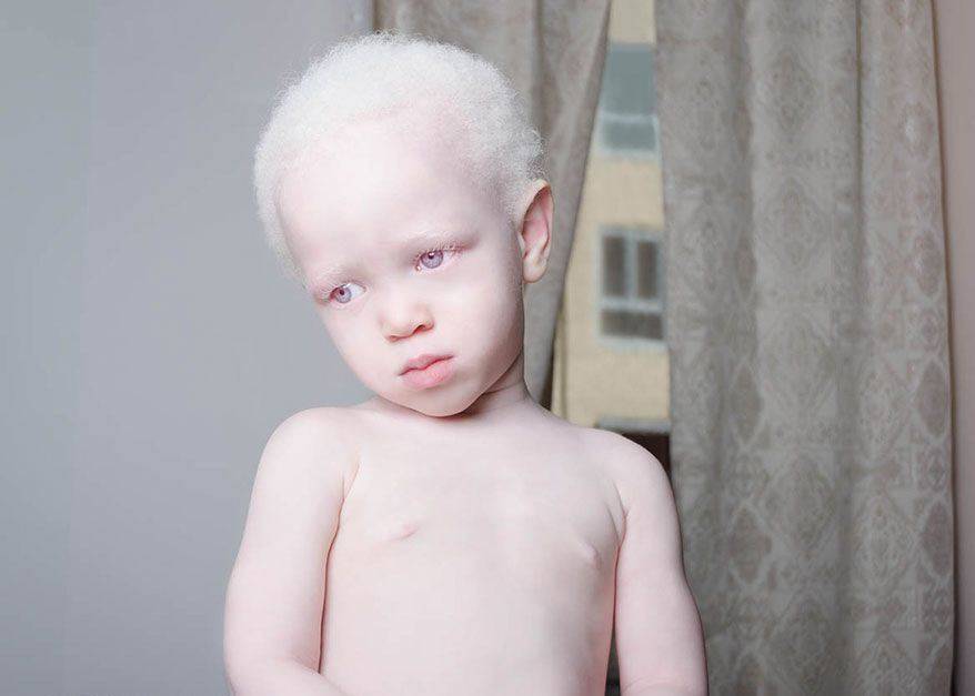 Офтальмология для детей с альбинизмом