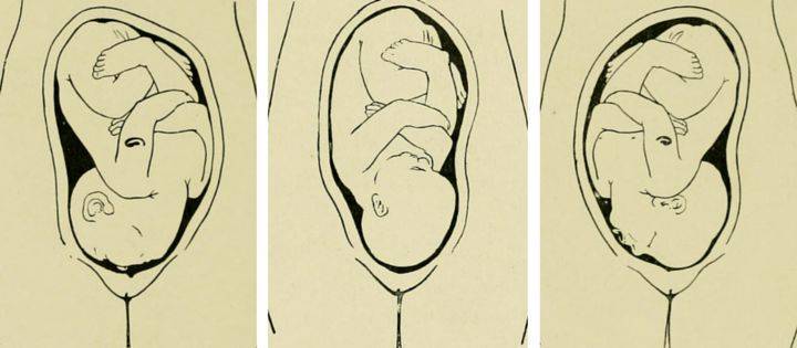 Тазовое предлежание плода на 20 неделе беременности фото