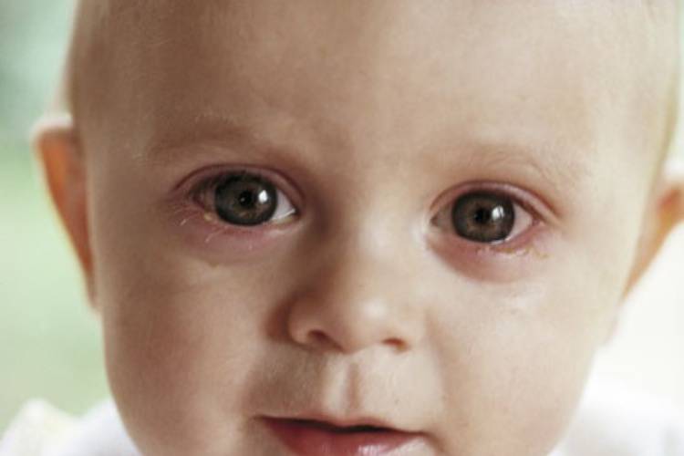 Признаки и лечение синдрома грефе у новорожденных детей