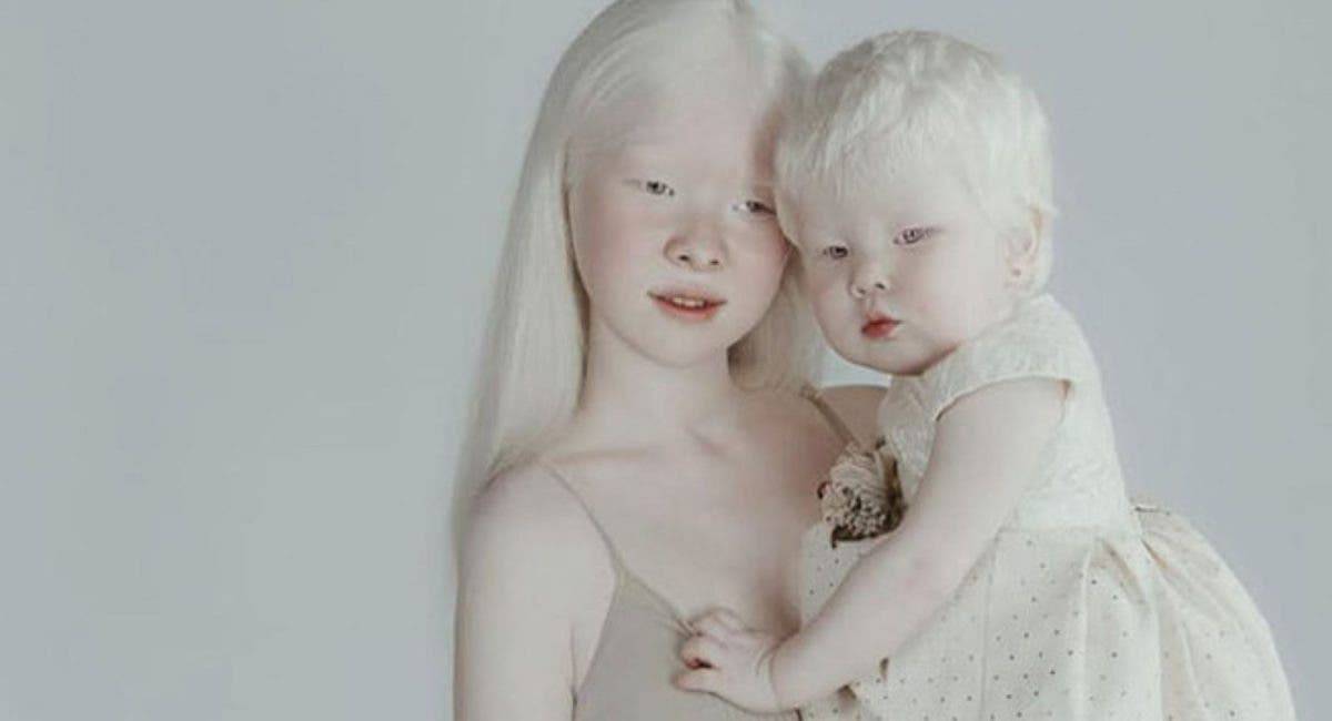«белая ворона», или особенности здоровья и развития ребенка-альбиноса. чем отличаются альбиносы глазной альбинизм