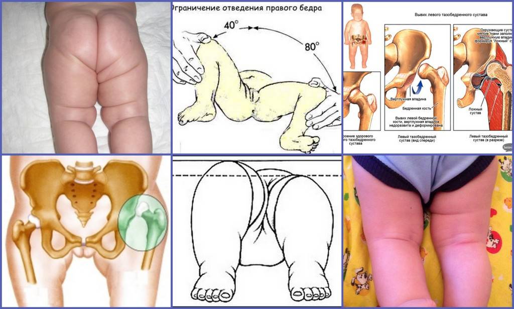 Дисплазия тазобедренных суставов у детей: как выявить и вылечить
