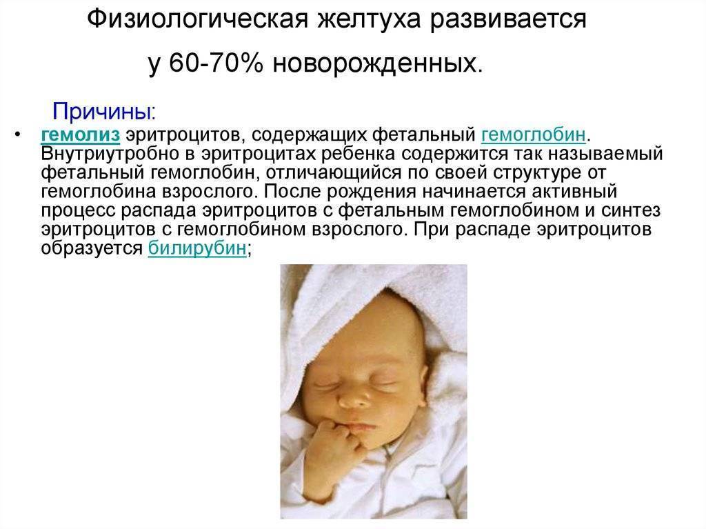 Желтуха у новорожденных – симптомы, виды, лечение