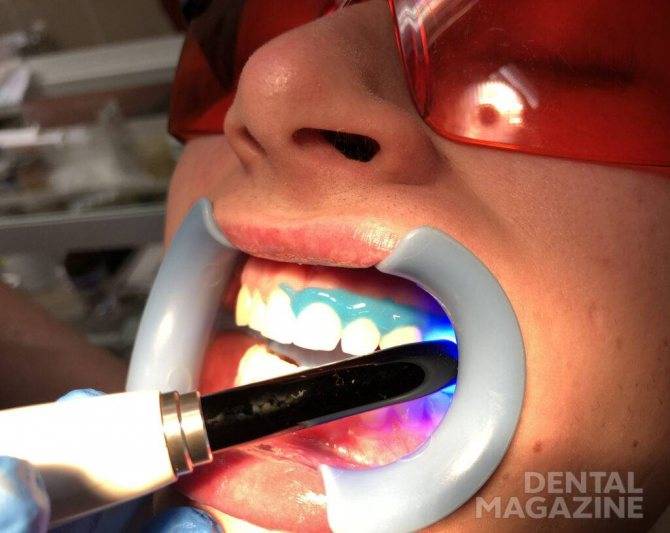 Ультразвуковая чистка зубов: цена, отзывы, преимущества, фото до и после