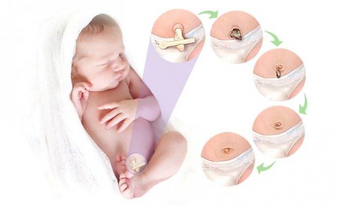 Как обработать пупок новорожденного - педиатрия на krasgmu.net