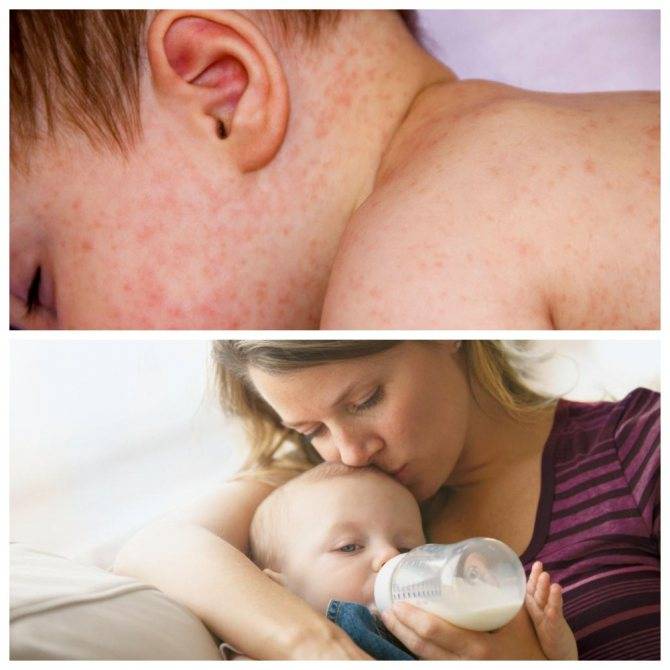 Если убрать аллерген через сколько пройдет сыпь у ребенка