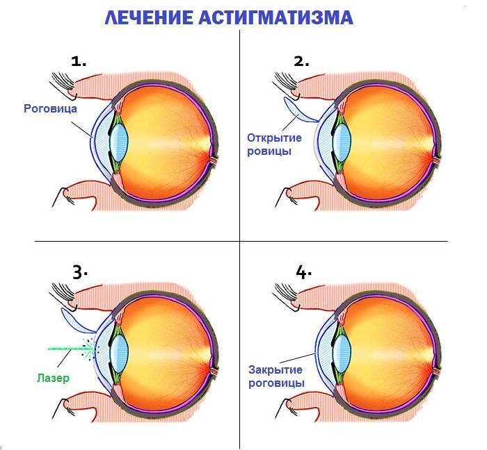 Причины дальнозоркости и способы ее коррекции в клинике микрохирургии глаза