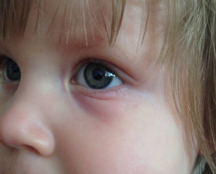 Синяки под глазами у ребенка: причины, симптомы, лечение