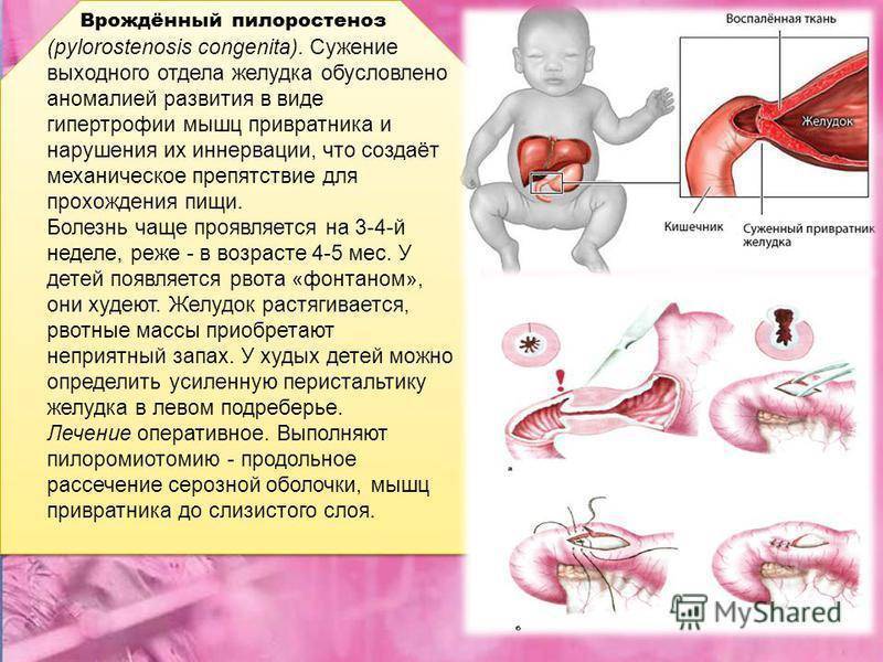 Пилоростеноз у новорожденных —причины, симптоматика, диагностика