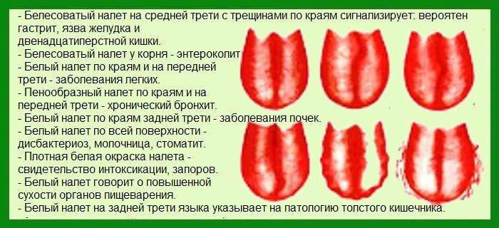 Трещины на языке - причины и методы лечения