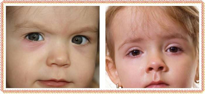 Врожденная катаракта у детей