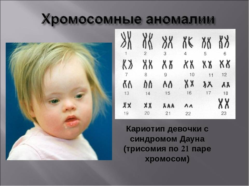 Молекулярно-цитогенетическая диагностика распространенных хромосомных нарушений (анеуплоидий) по 13,16,18,21,22,x,y-хромосом