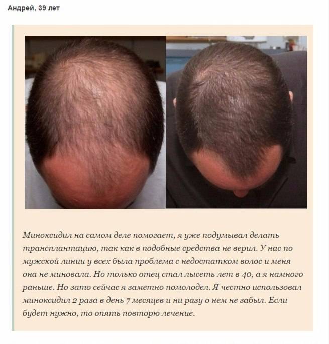 Что делать, если редеют волосы у мужчины на голове?