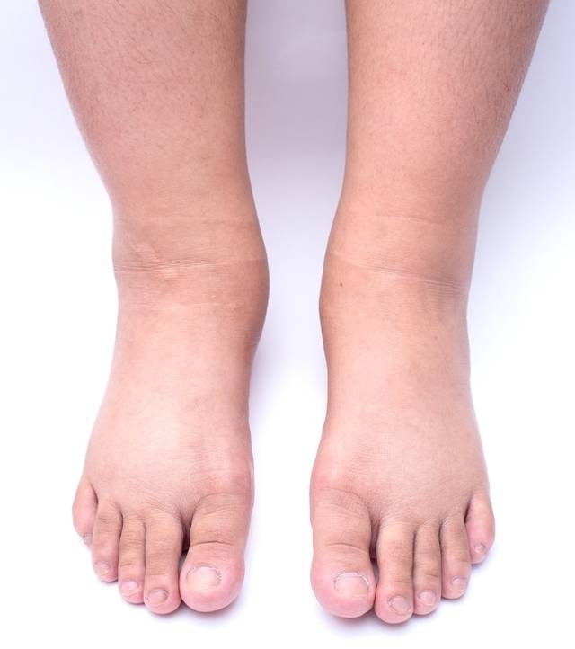 Отёки ног при беременности: норма или патология | клиника «гармония»