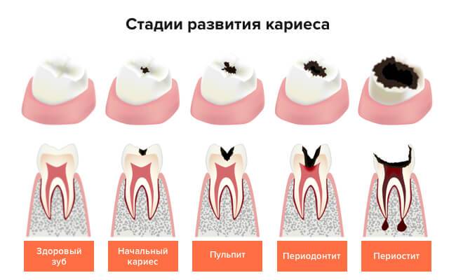 Оголение шейки зуба: причины оголения шейки зуба, лечение заболевания