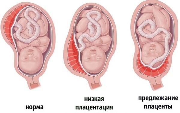 Низкая плацентация: каждый миллиметр на счету - наблюдение беременности.  здоровье