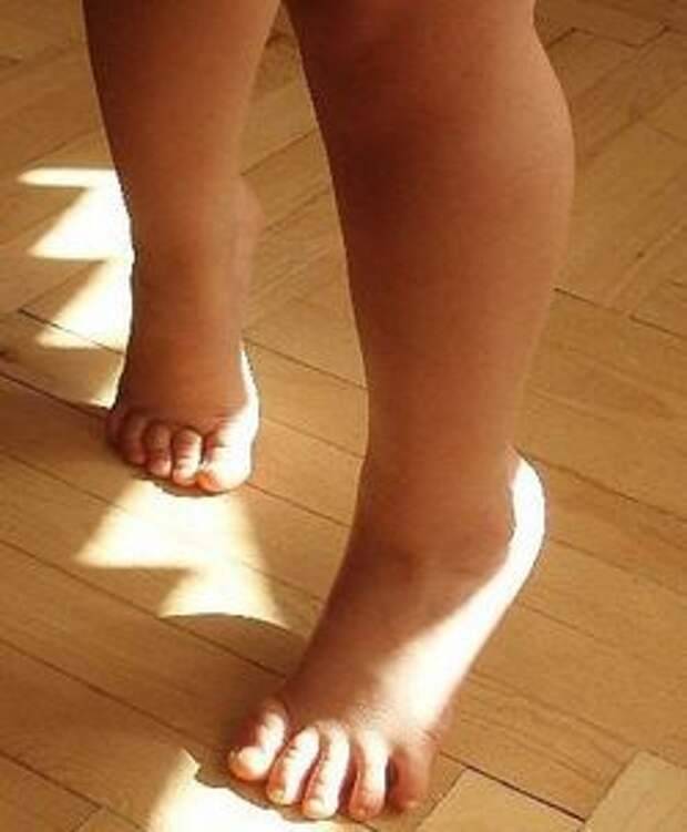 Ребенок ходит на носочках: норма и патология – нейроспектр