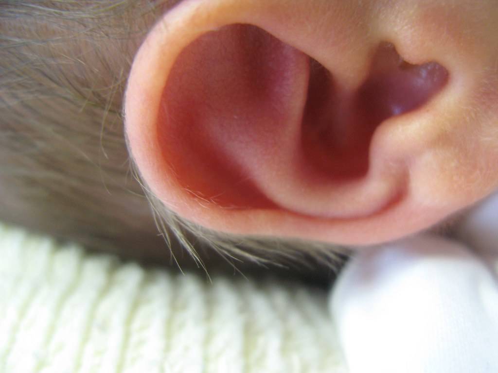 Почему у ребёнка разные уши? микротия – врожденный дефект ушной раковины или ее полное отсутствие