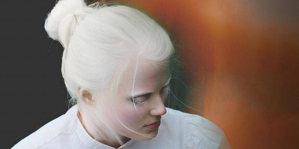 Альбинизм - причины и симптомы, диагностика и лечение альбинизма