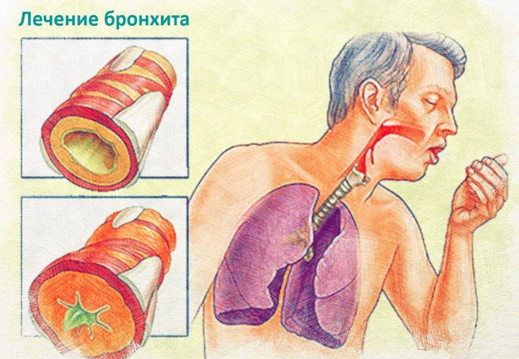 Как распознать пневмонию — первые признаки, признаки пневмонии у грудничка