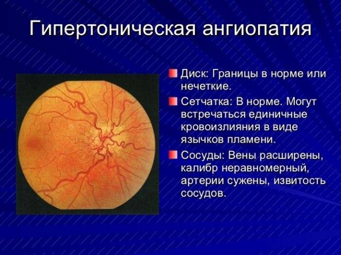 Фоновая (вторичная) ретинопатия