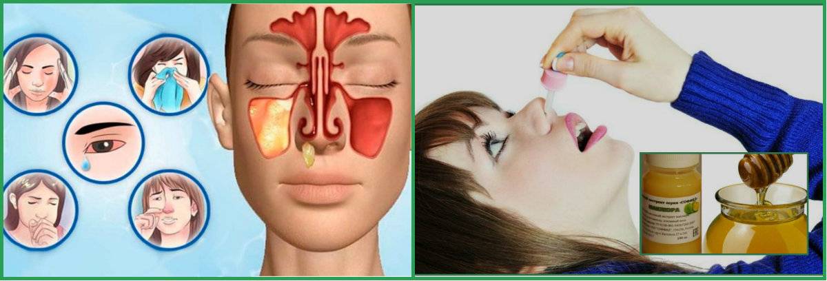Лечение носа у взрослых. Синусит и гайморит лекарство. Лекарство для гайморовых пазух носа. При гайморите взрослым.