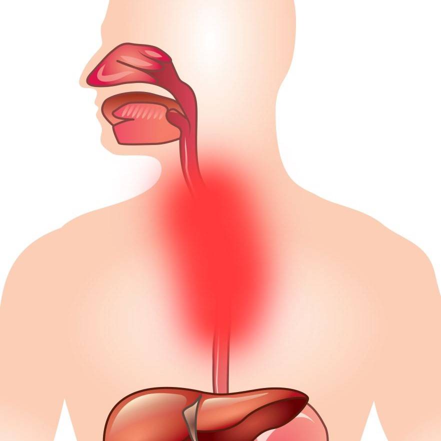 Воспаление пищевода. Эзофагит рефлюкс-эзофагит. Рефлюкс эзофагит эрозия. Хронический рефлюкс эзофагит. Болезнь желудка рефлюкс эзофагит.