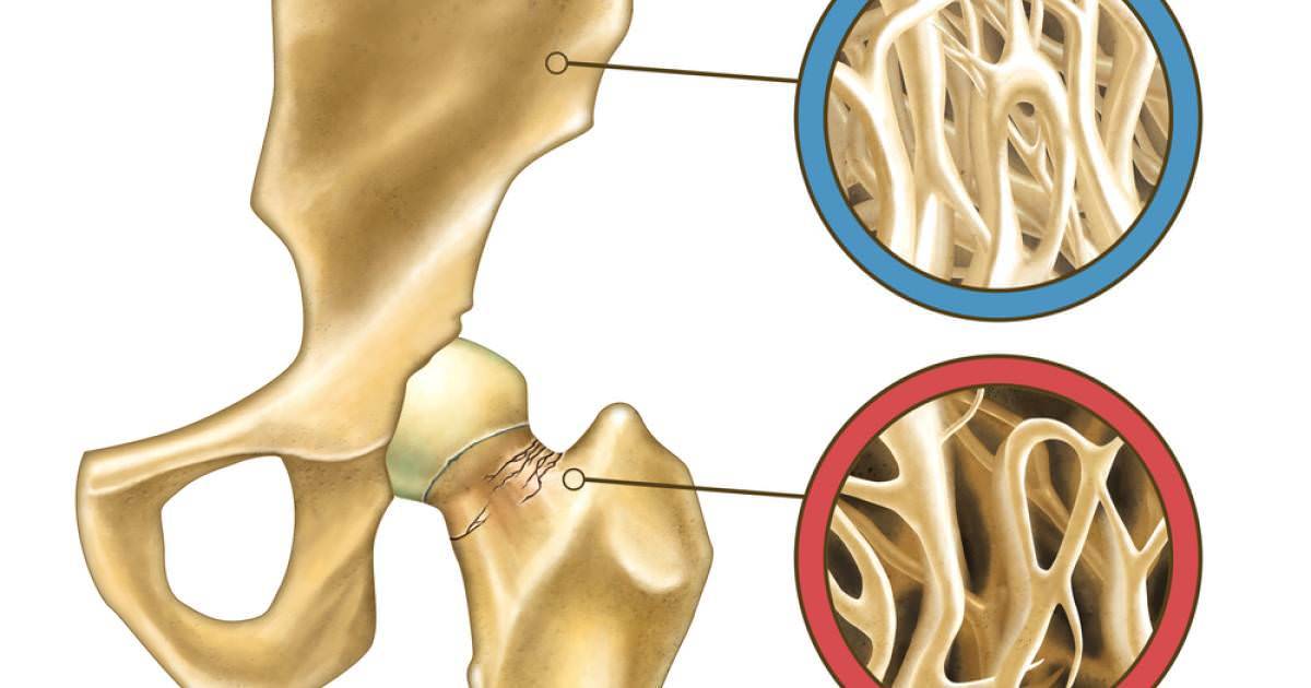 Остеопороз: симптомы, факторы риска, диагностика и лечение заболевания скелета