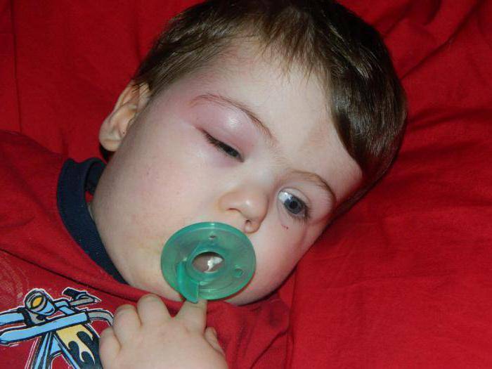 После укуса комара опухла рука у ребенка или взрослого, первая помощь