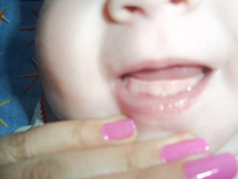 У ребенка криво растут молочные зубы: что делать если передние и нижние зубы растут криво