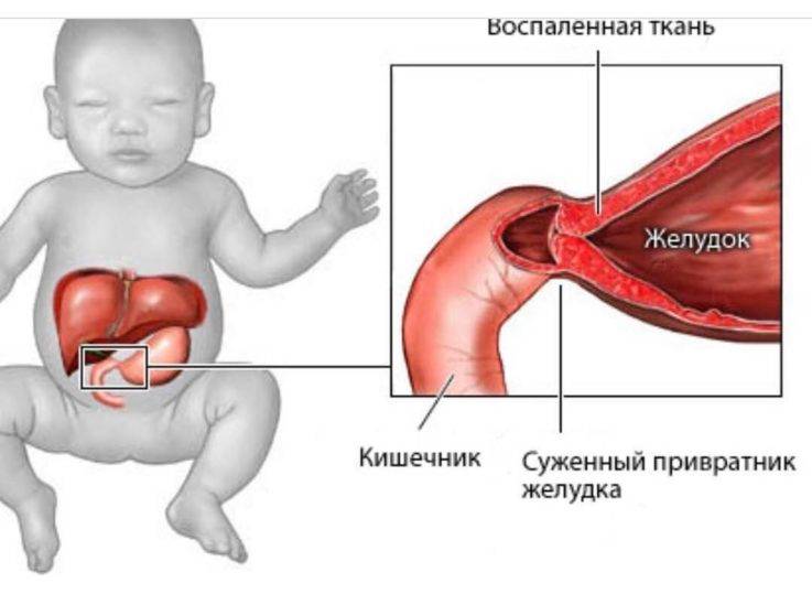 Стеноз привратника желудка (пилоростеноз) у детей - доказательная медицина для всех