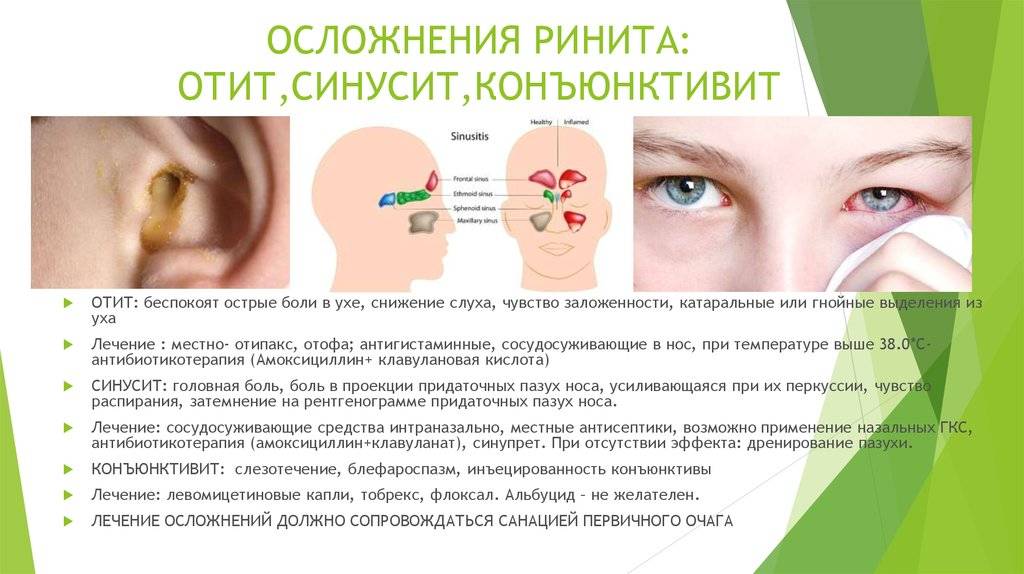 Лечение гайморита без прокола: как эффективно вылечить хронический гайморит у лор-врача в москве