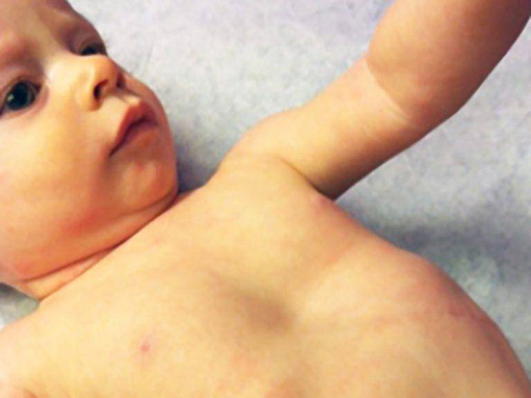 Впалая грудная клетка у ребенка — причина и лечение