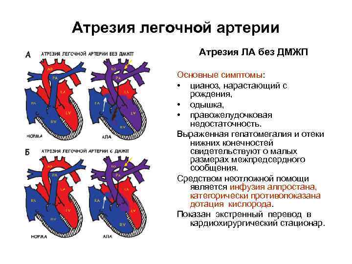 Дефект межжелудочковой перегородки (дмжп) сердца у детей и