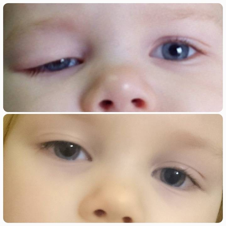 У ребенка один глаз больше другого: причины - "здоровое око"