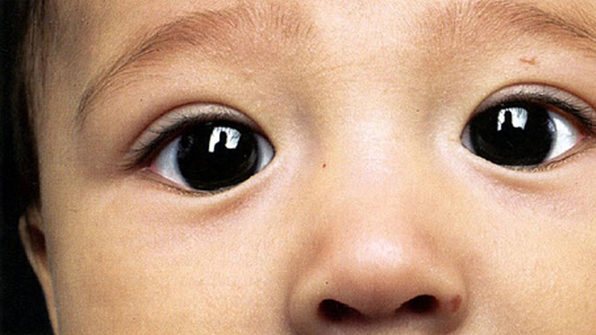 Почему у новорожденного ребенка косые глаза