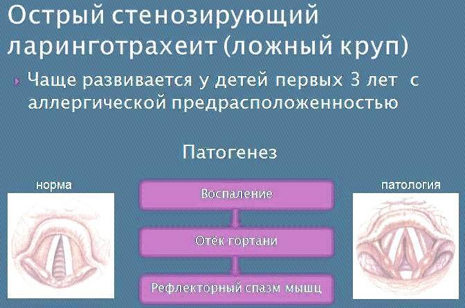 Стенозирующий ларинготрахеит презентация