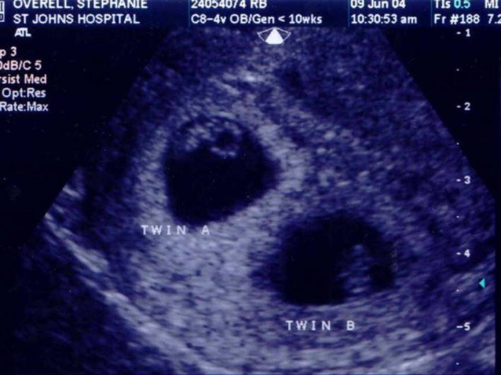 Первые признаки беременности двойней на раннем сроке до задержки месячных