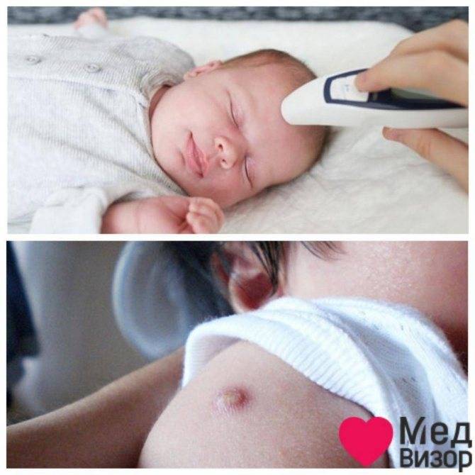 Прививка бцж новорожденным и старшим детям, реакции и осложнения после прививки бцж - здоровый образ жизни