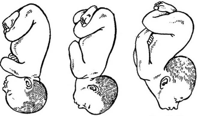 Упражнения чтобы ребенок перевернулся головой вниз при тазовом предлежании: как перевернуть ребенка в головное положение