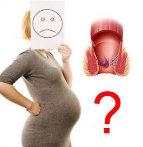 Геморрой при беременности - что делать, как и чем лечить - полезные материалы