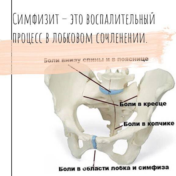 Артроз симфиза лобковых костей
