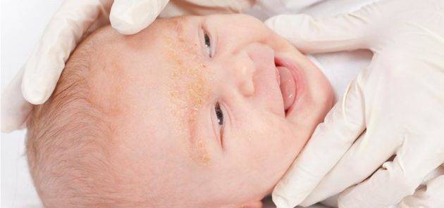 Как отличить акне новорожденных от аллергии? особенности, отличия, причины появления, нужно ли лечить