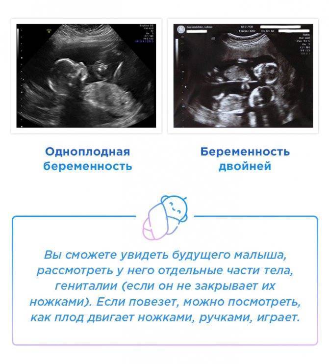 Беременность двойней по неделям, особенности беременности близнецами, развитие плода с фото |
            эко-блог