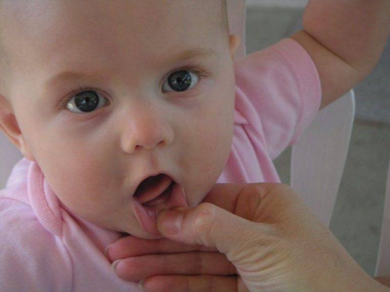 Причины белого налета на языке у ребенка