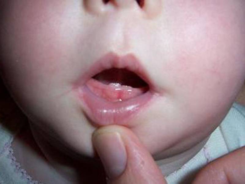 Как понять что лезут зубы у ребенка: признаки, симптомы, порядок прорезывания зубов